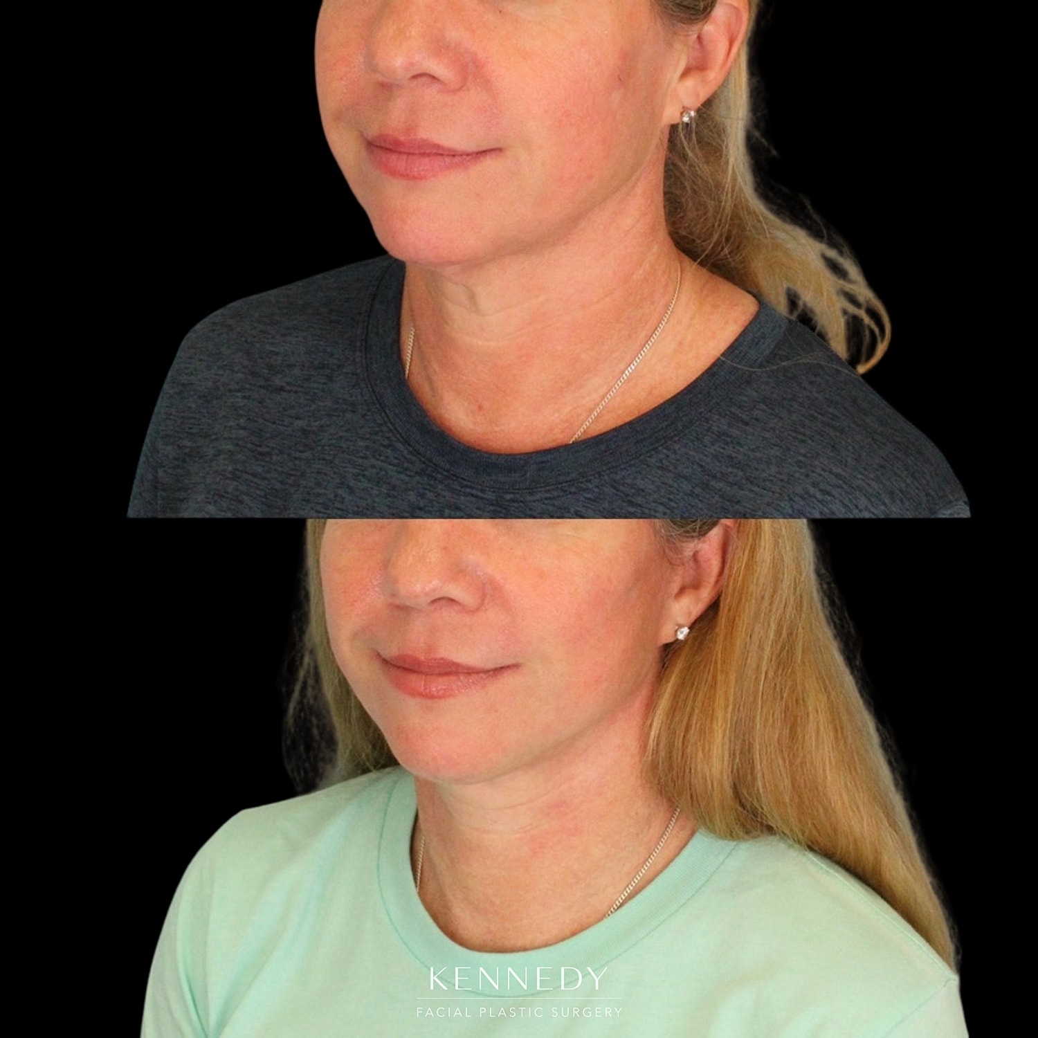 Facelift Before & After