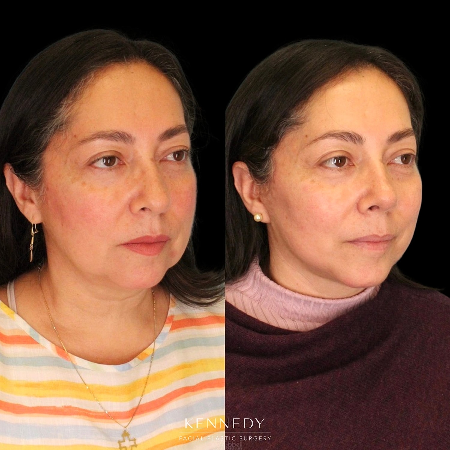 Facelift Before & After