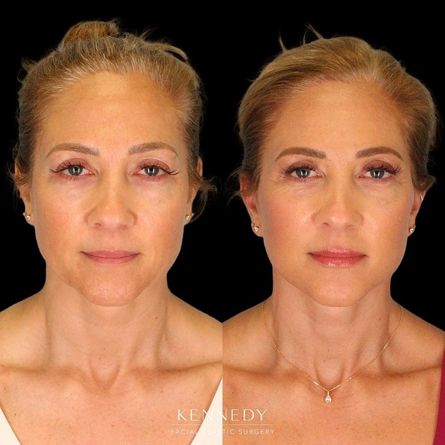 Facelift Before & After