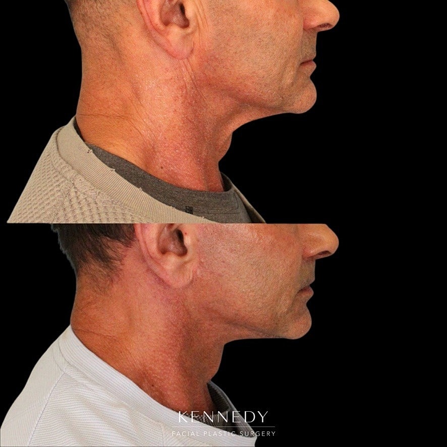 Facelift Before & After