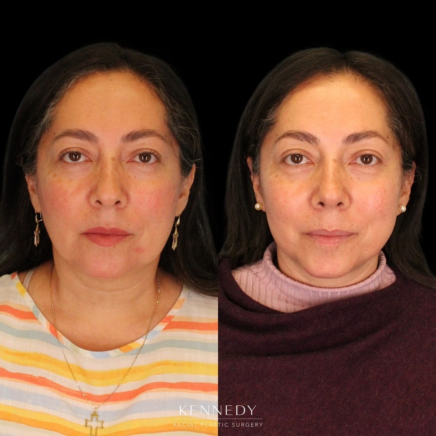 Rhinoplasty Before & After