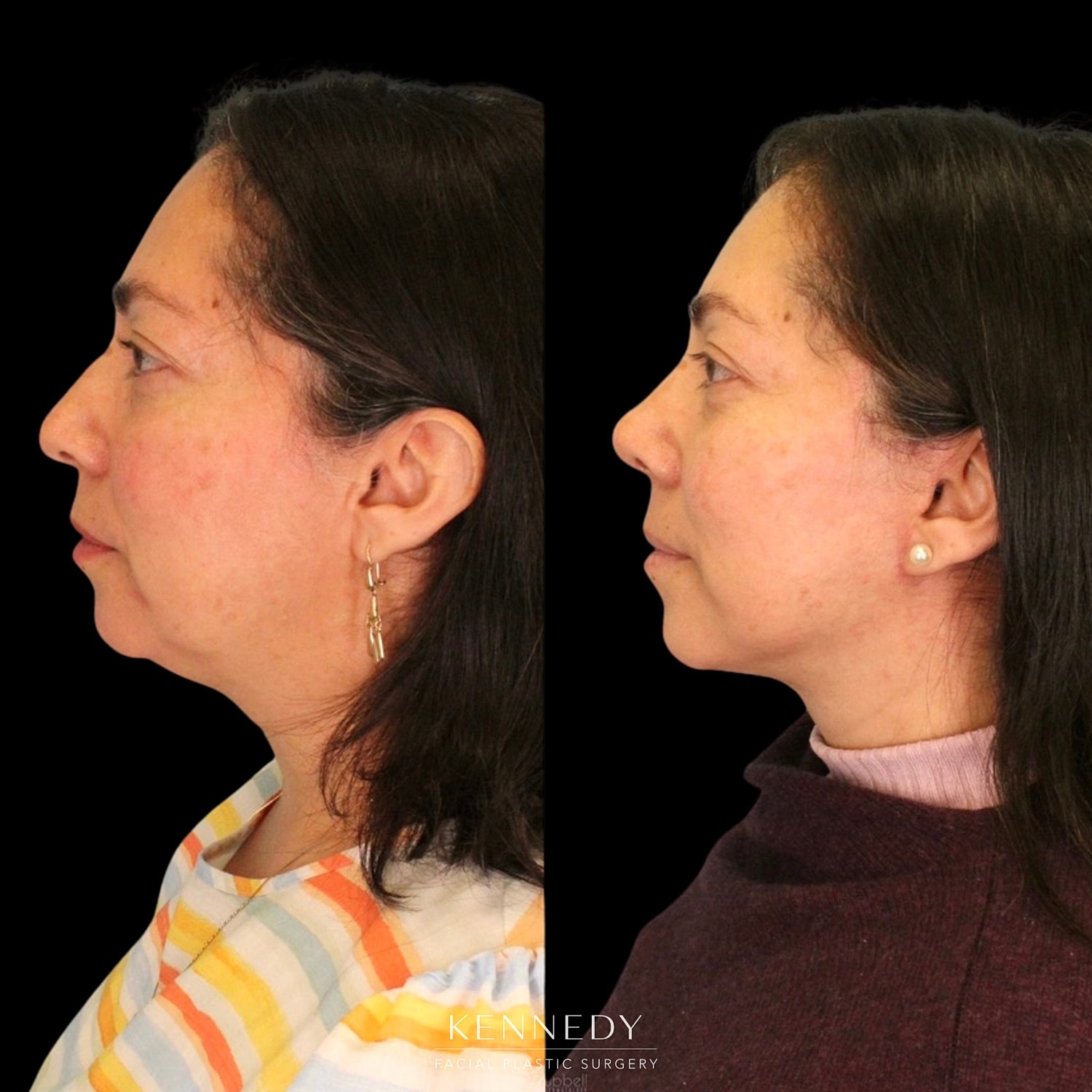Rhinoplasty Before & After
