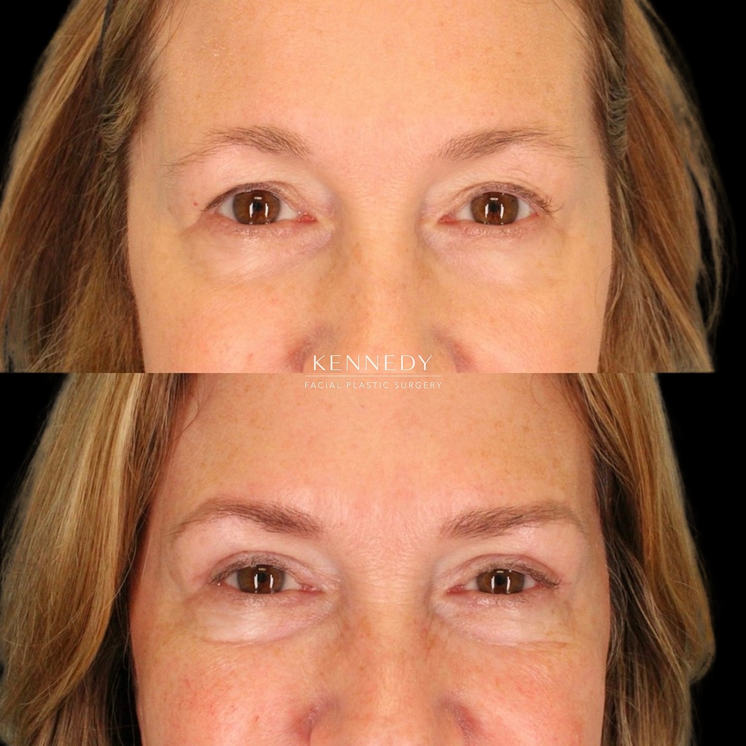 Brow Lift Before & After