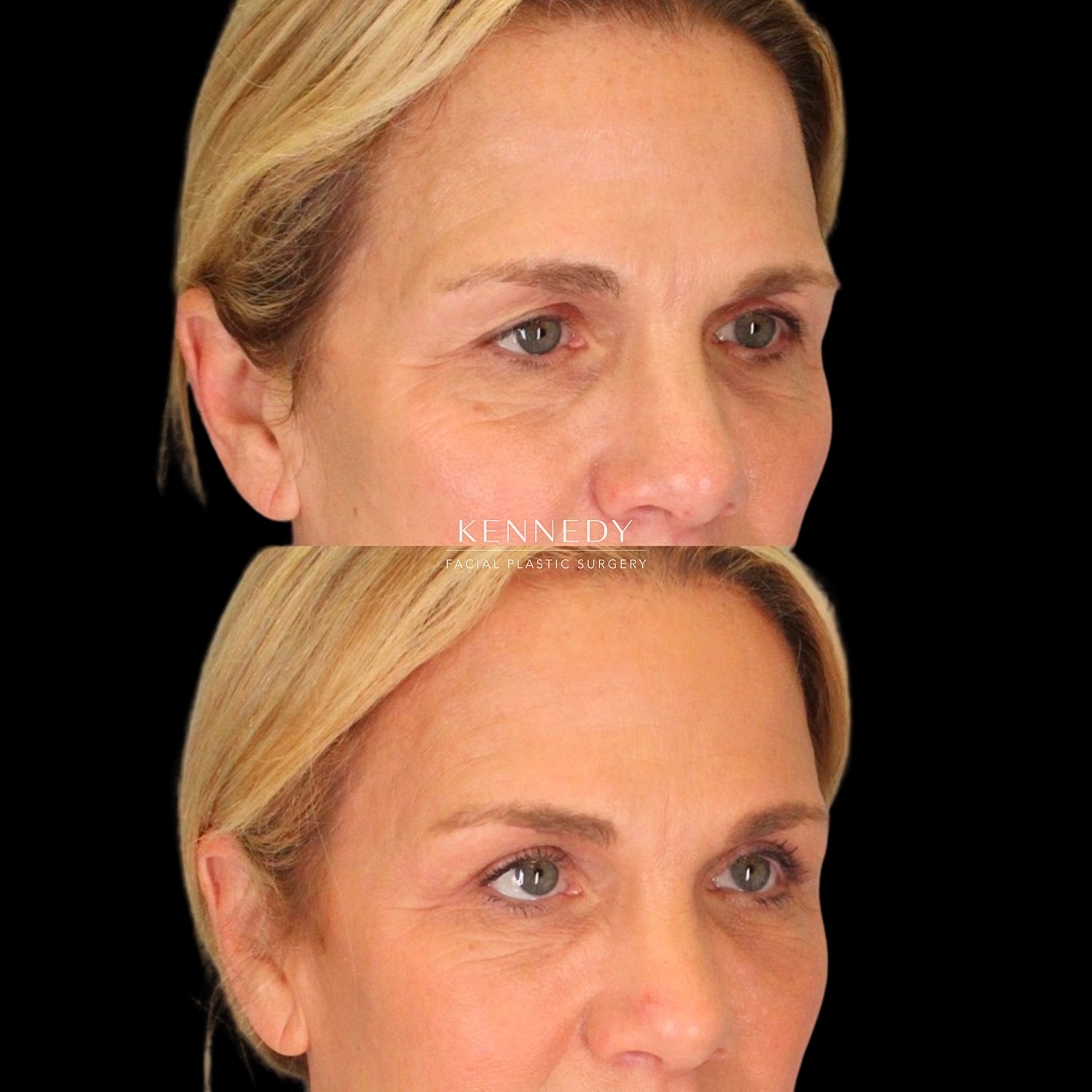 Brow Lift Before & After